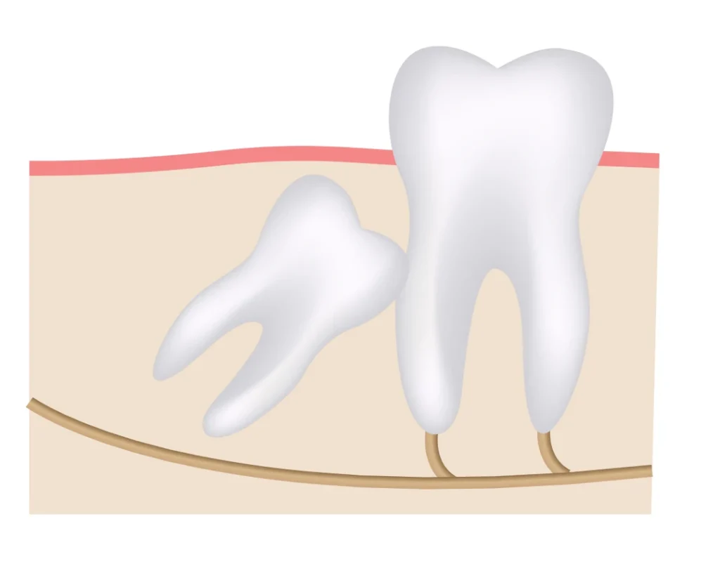 Extraction dents de sagesse