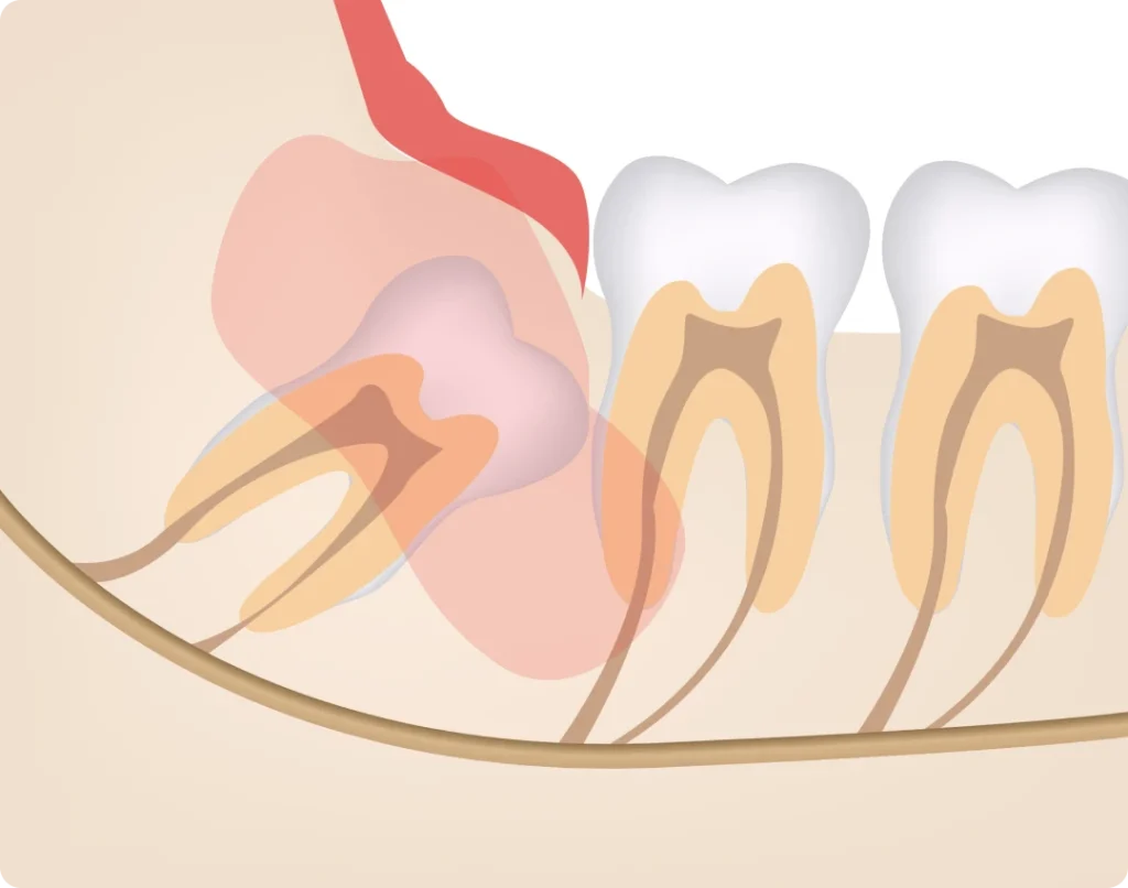 Extraction dents de sagesse