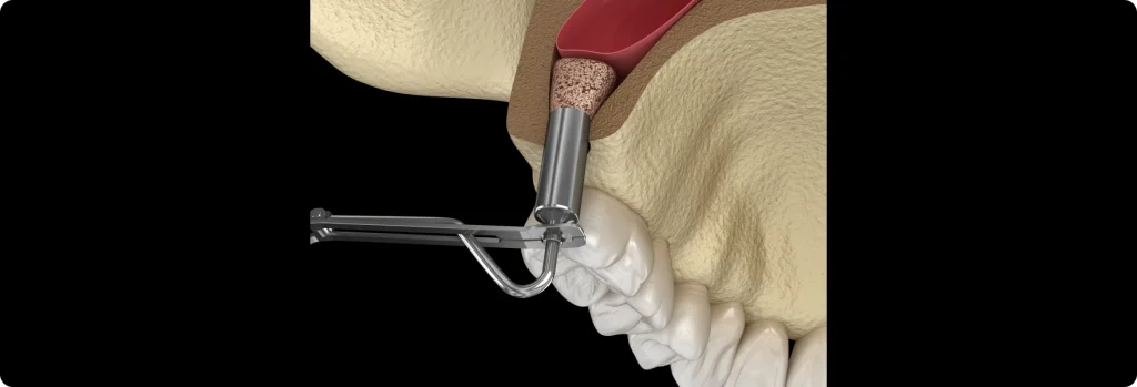 Chirurgie du sinus ou sinus lift