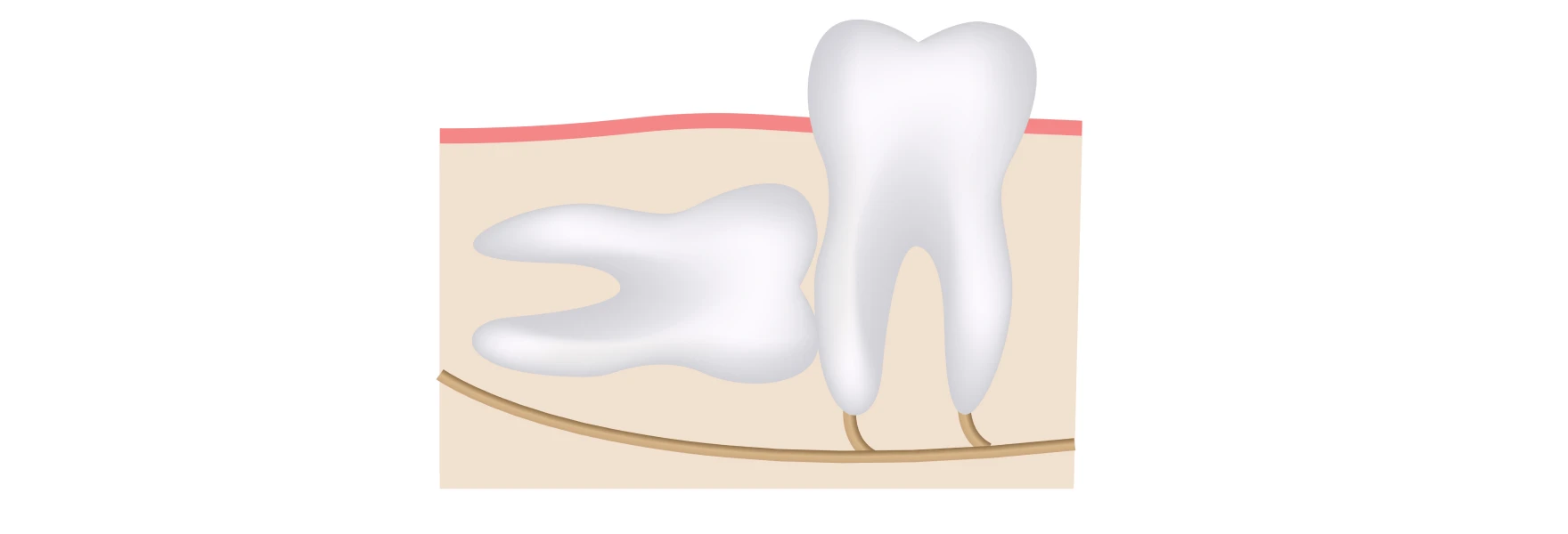 Dégagement de dents incluses