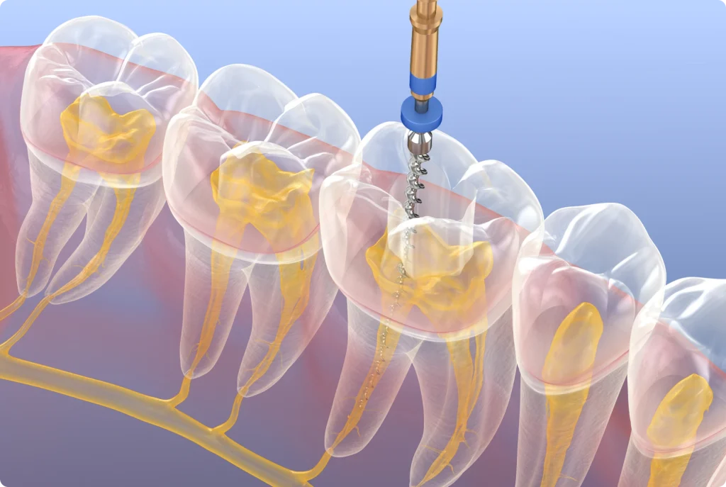 Endodontie : le traitement de racine