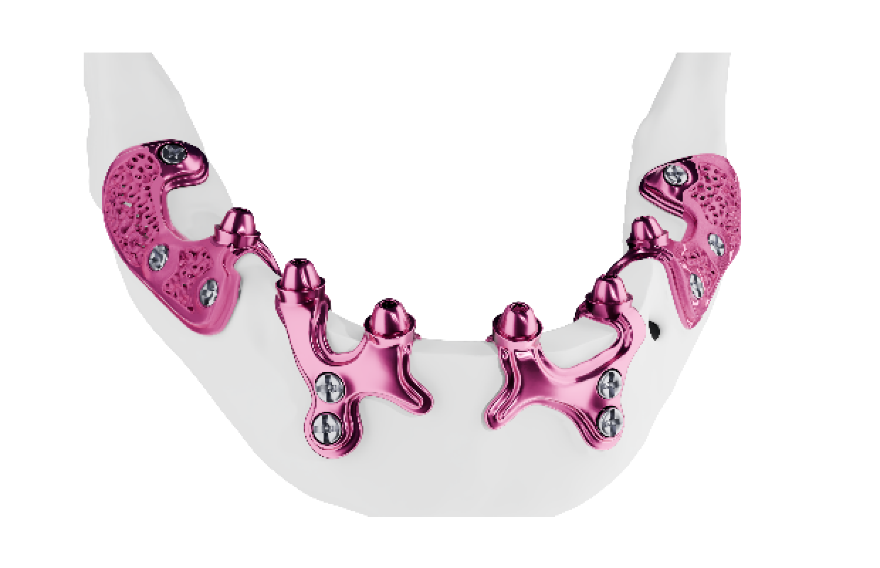 Les implants sous-périostés