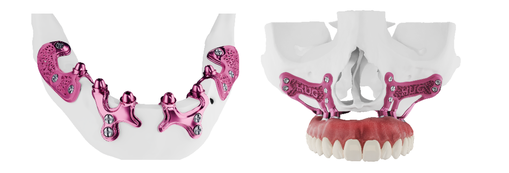 Les implants sous-périostés