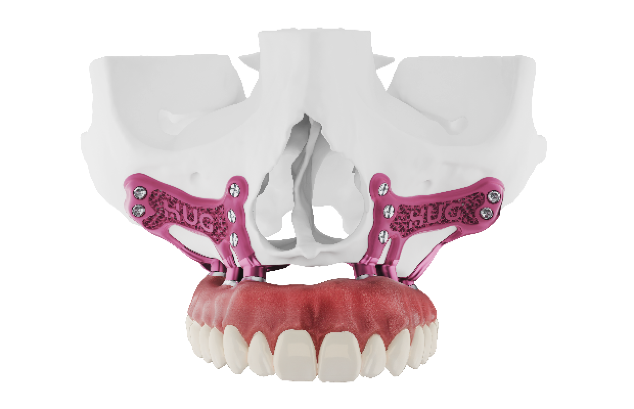 Les implants sous-périostés